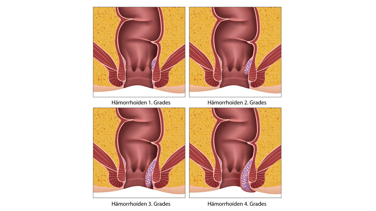 Hämorrhoiden Grafik