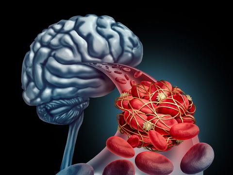 Hirnvenenthrombose: Symptome und Ursachen