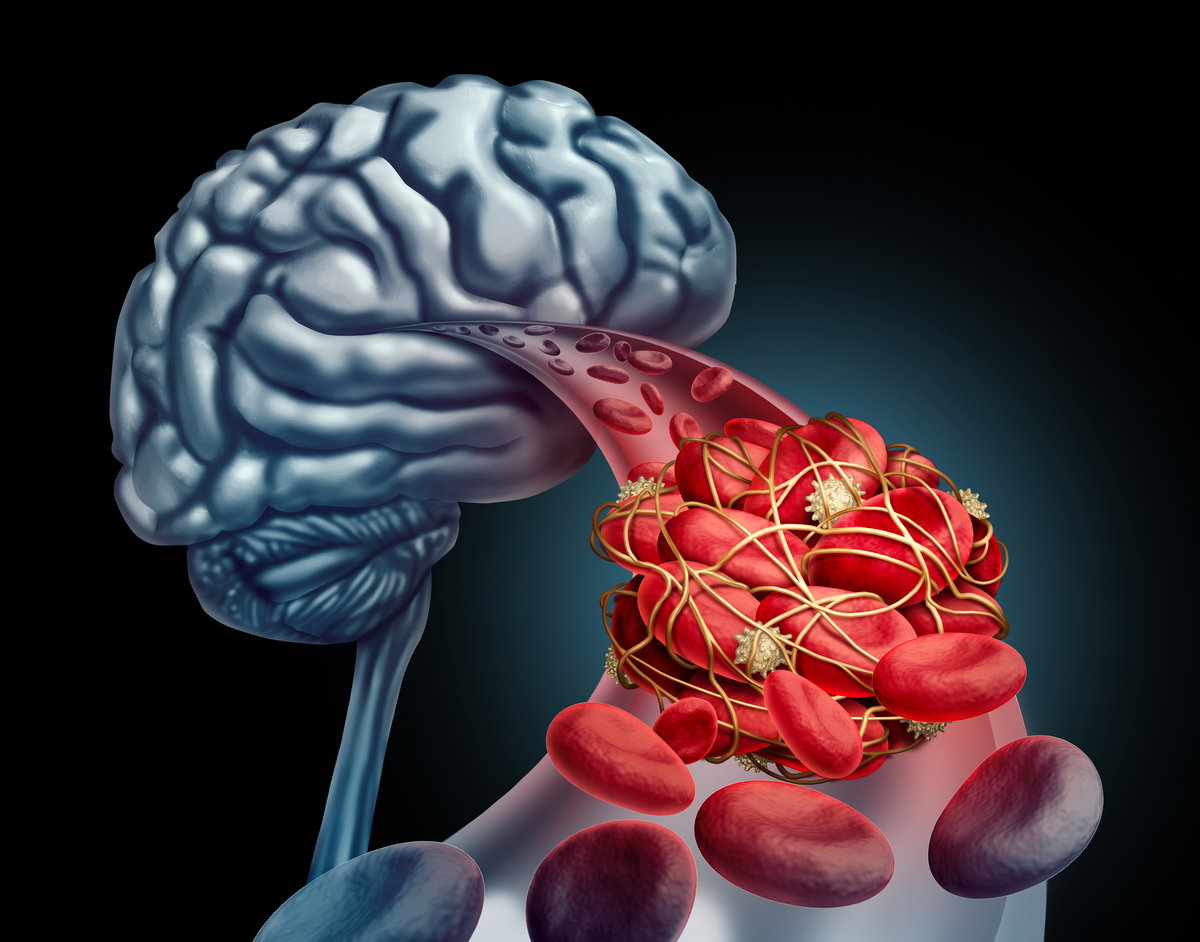 Hirnvenenthrombose