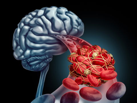 Hirnvenenthrombose: Symptome und Ursachen