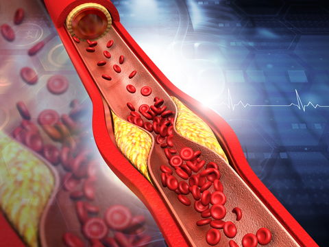 Erhöhtes Cholesterin im Gesicht erkennen: Achten Sie auf diese Symptome