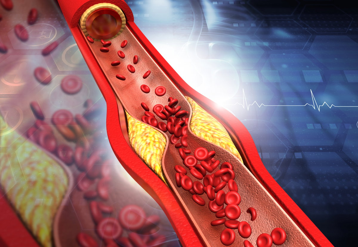 Hohe LDL-Cholesterinspiegel können zu einer Anhäufung von Cholesterin in den Arterien führen