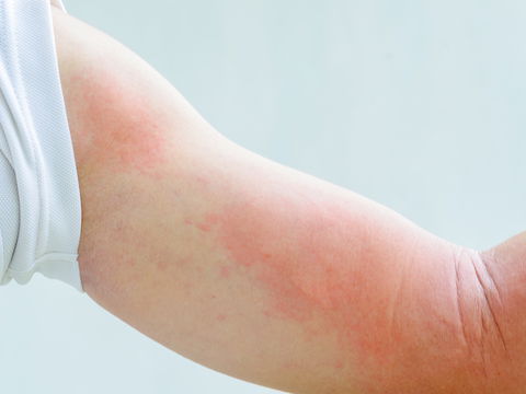 Hautausschlag nach Corona-Impfung: Das hilft gegen die Beschwerden