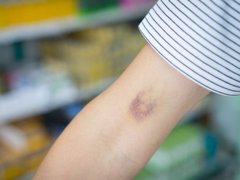 Blaue Flecke: Wann sind sie gefährlich?