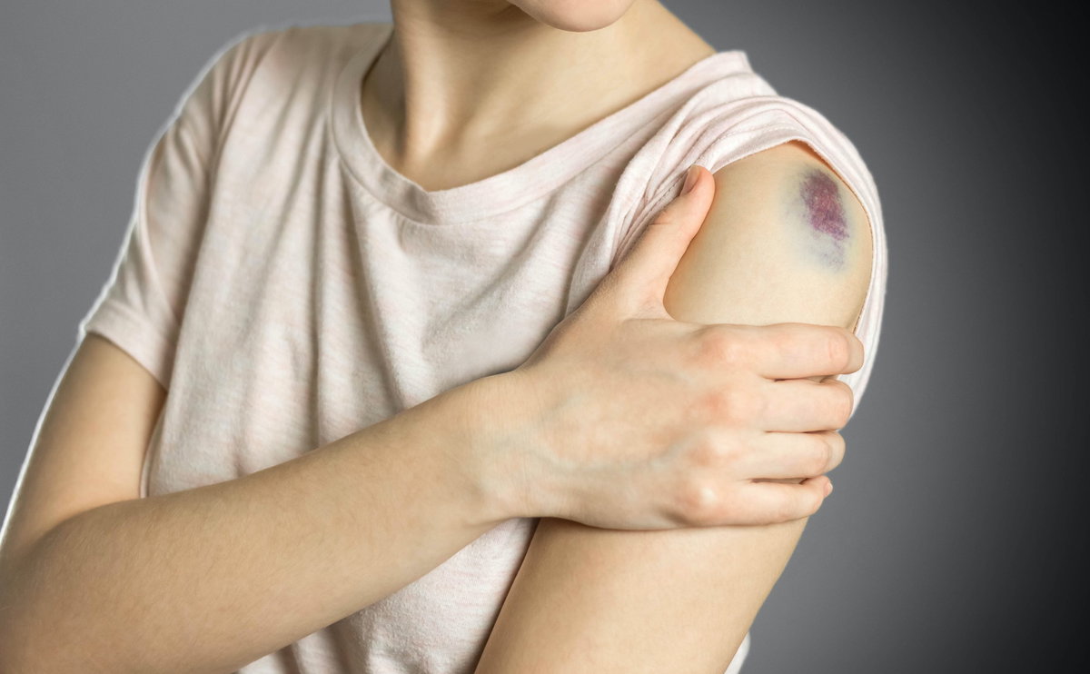 Blauer Fleck am Arm