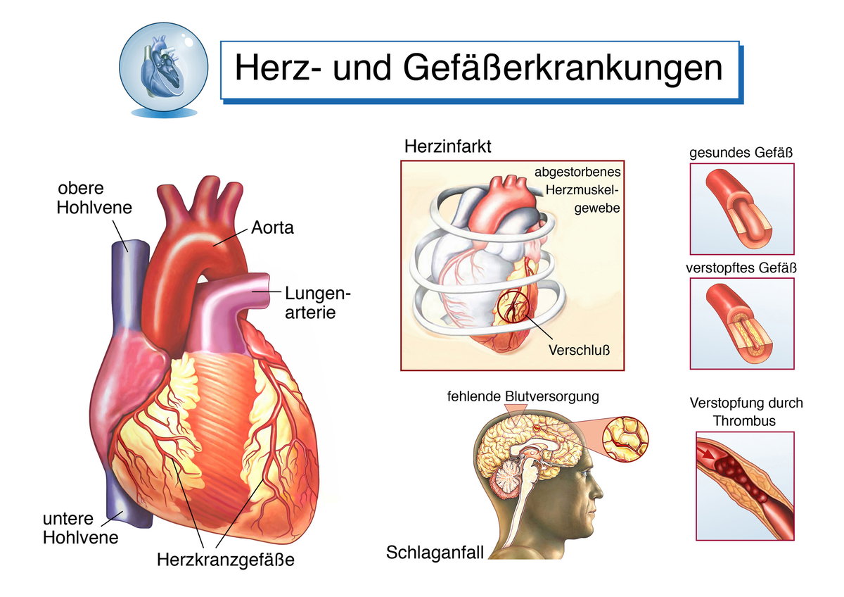 Infografik zu Herz- und Gefäßerkrankungen