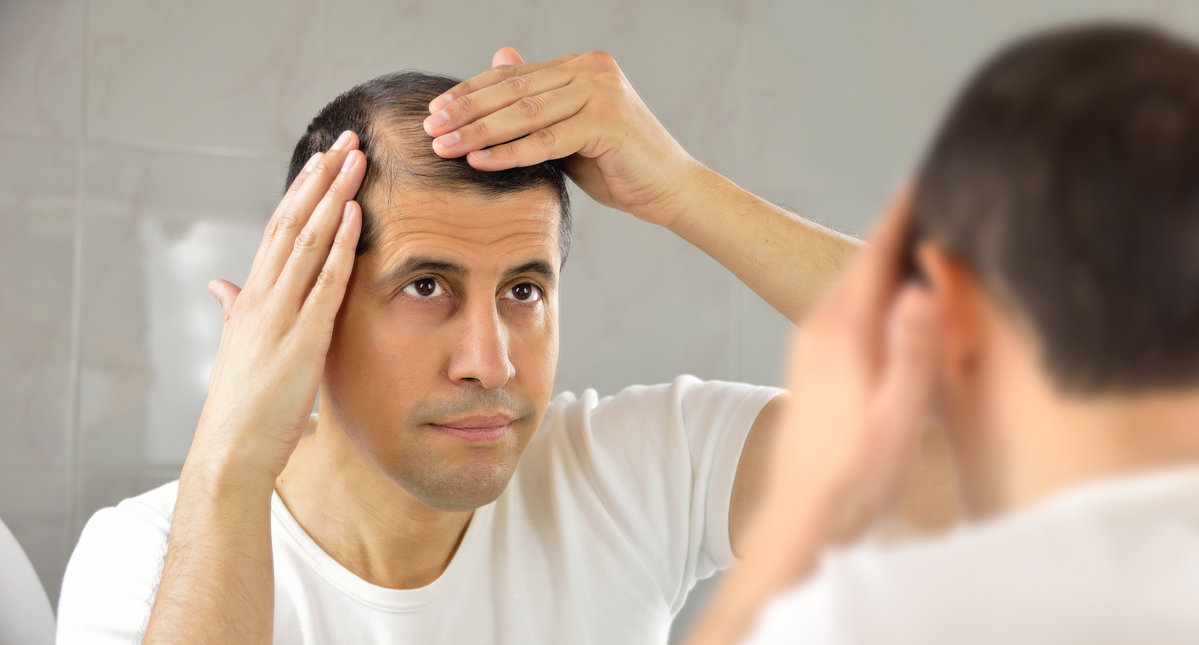 Mann mit Haarausfall