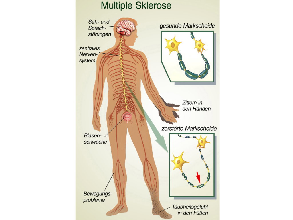 Grafische Darstellung der Krankheit Multiple Sklerose