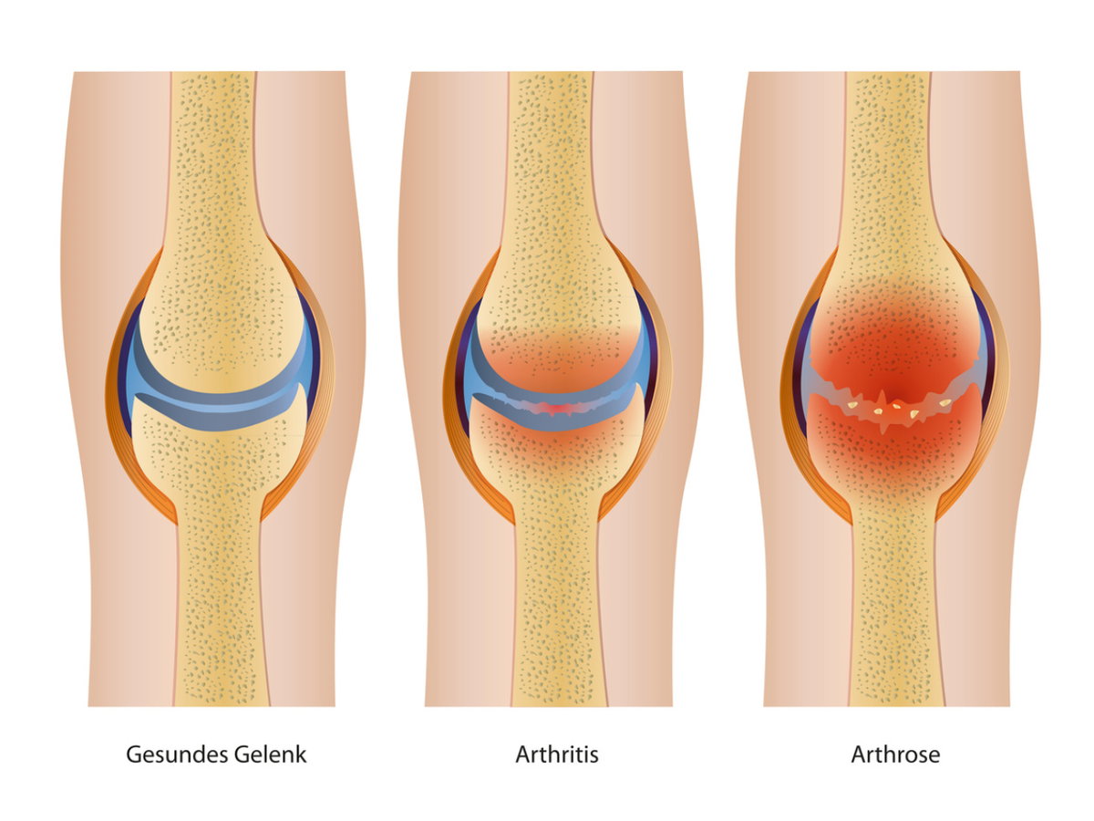Grafische Darstellung von Arthritis und Arthrose