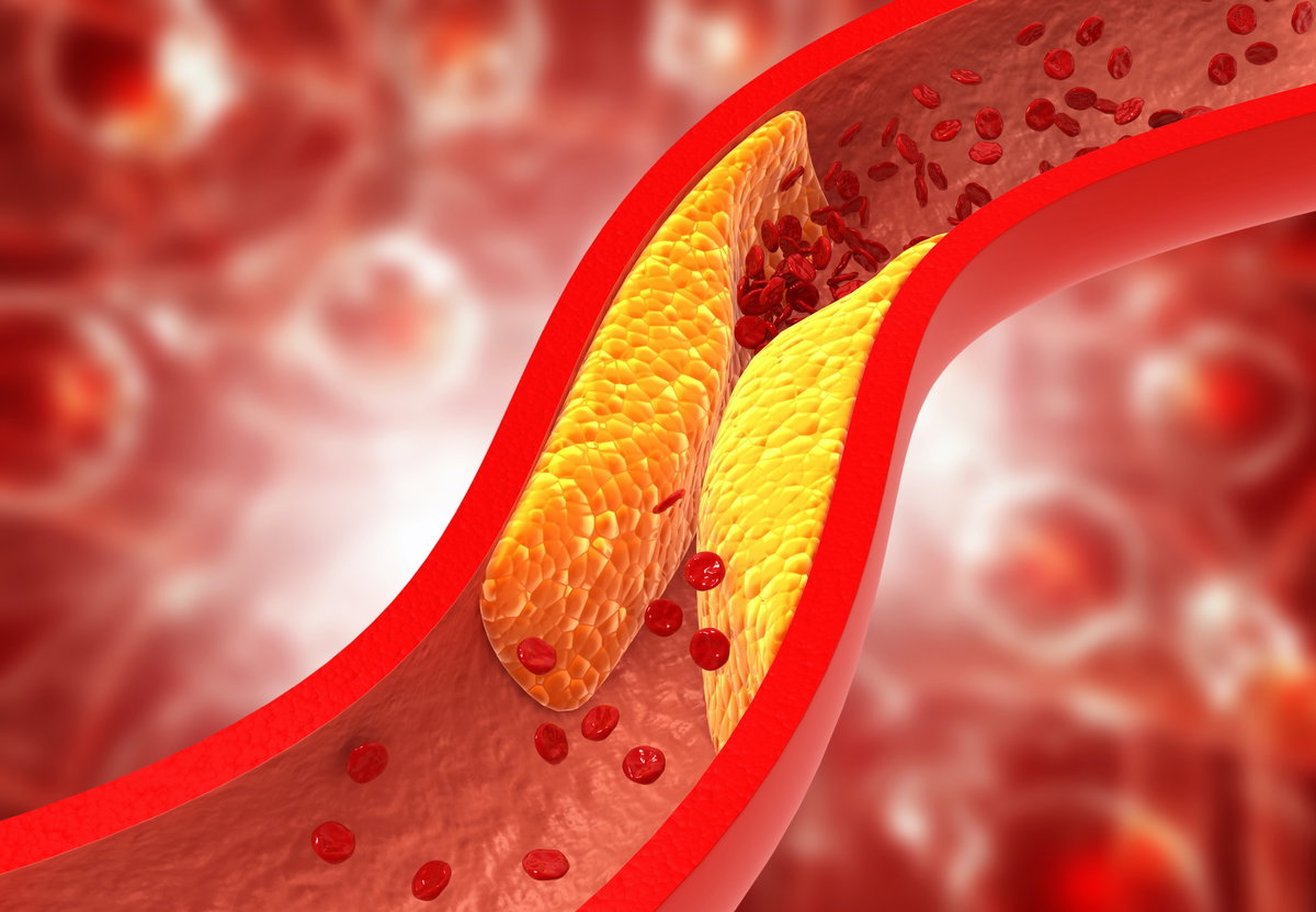 Verstopfte Arterien