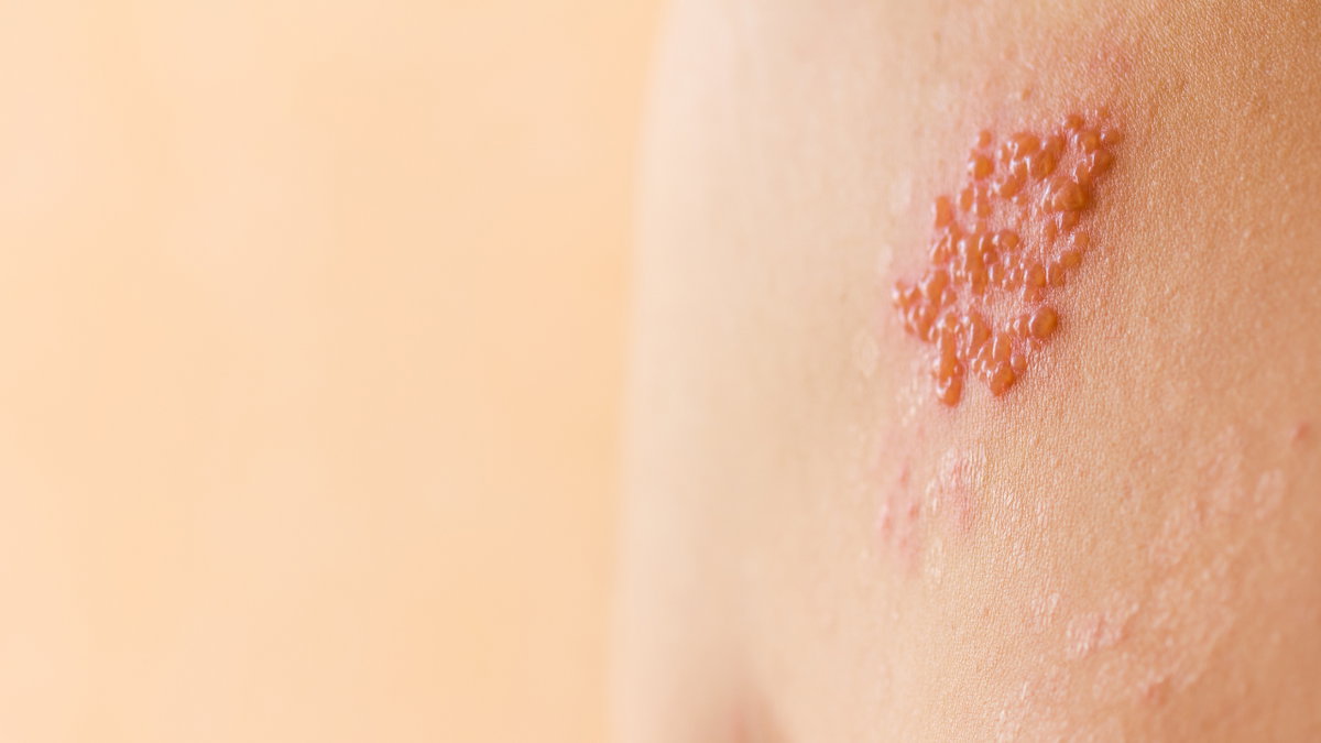 Starke Belastungen können das Immunsystem schwächen und zu Gürtelrose führen.