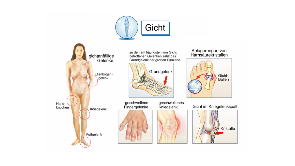 Infografik zur Gicht