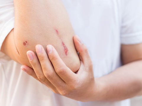 Blutvergiftung: Diese Anzeichen deuten auf eine Sepsis