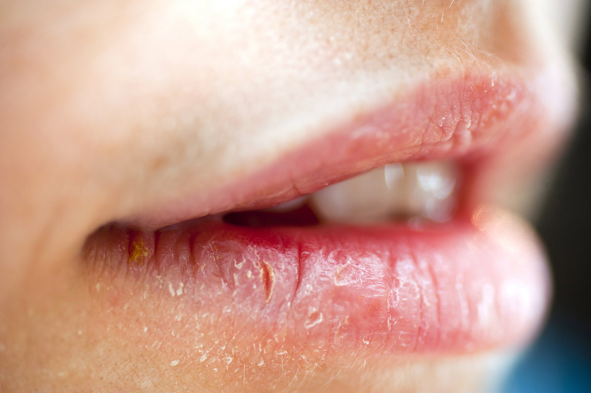 Wunde Lippen