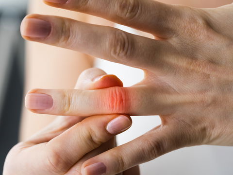 Arthrose in den Fingern: Diese 11 Hausmittel helfen
