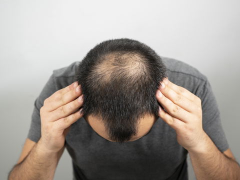 Kreisrunder Haarausfall: Die 5 besten Tipps zur Behandlung