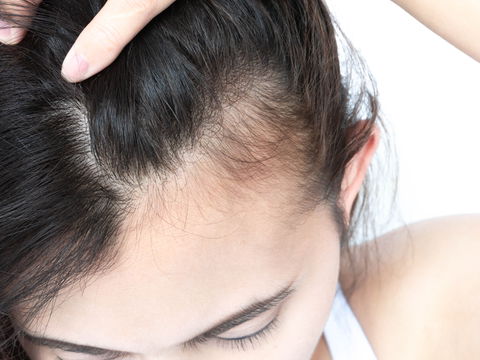 Dünnes Haar: 4 Nährstoffe, die Ihnen fehlen könnten
