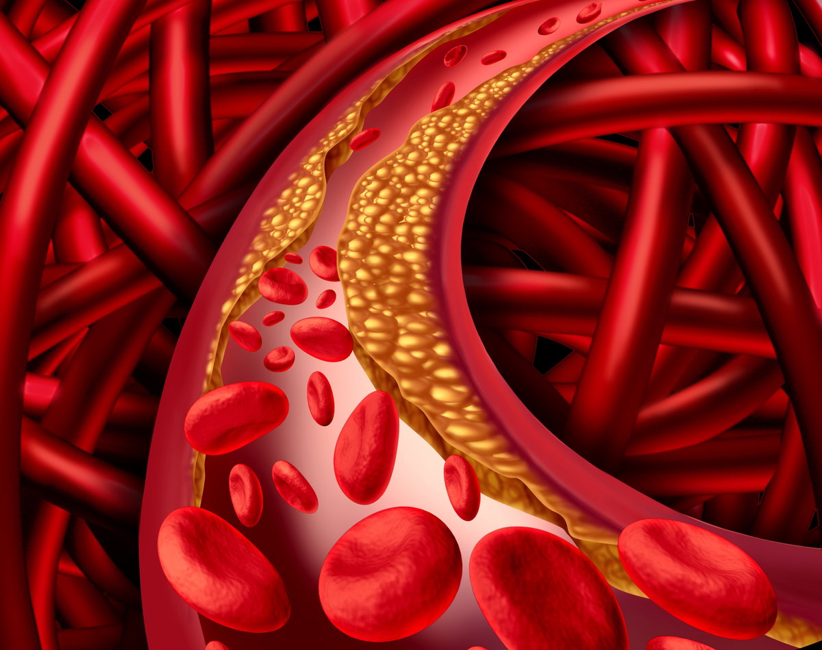 Menschen mit hohem Risiko für Herz-Kreislauf-Erkrankungen sollten ihr Cholesterin senken.
