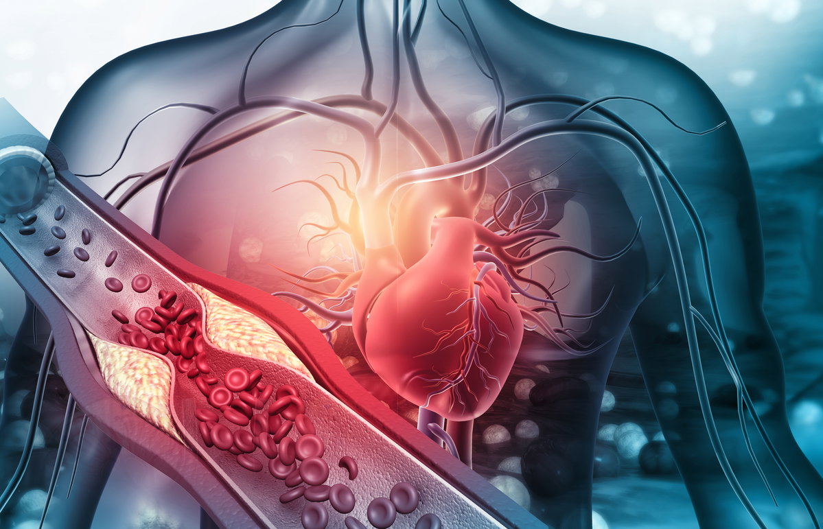 Herz verstopfte Arterien