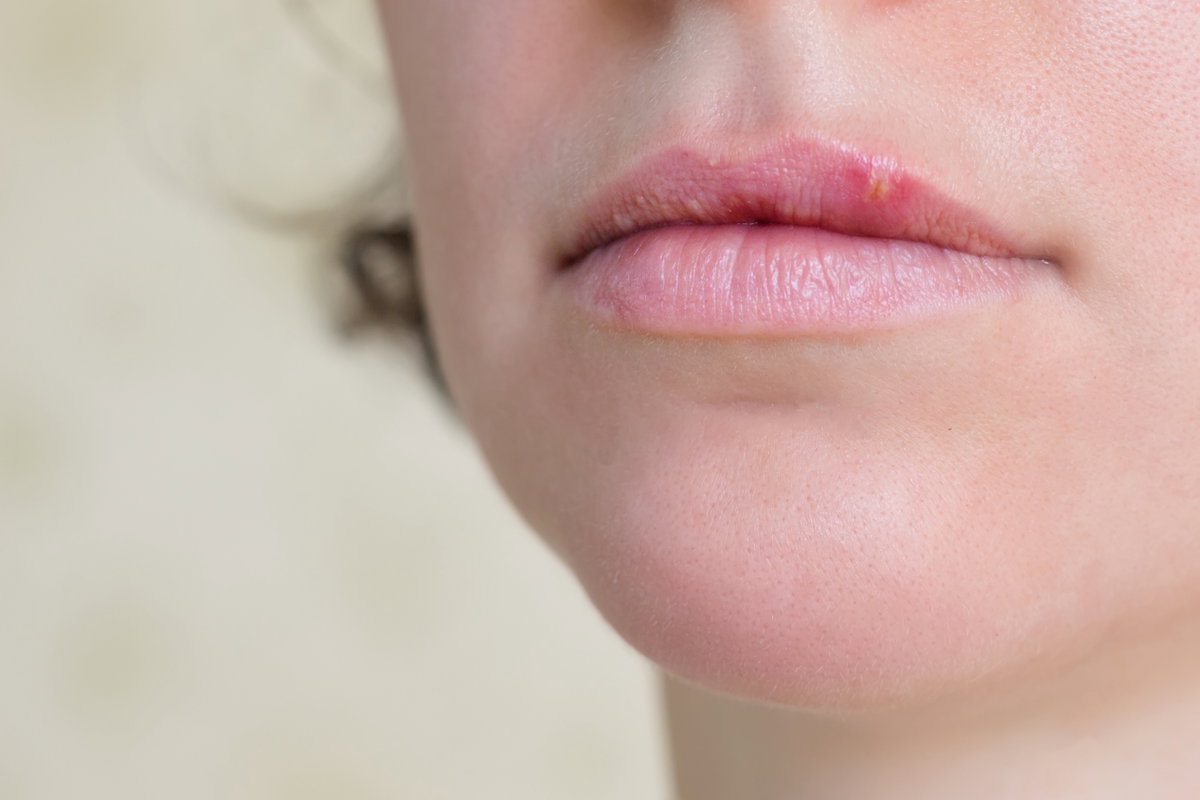 Frau mit Lippenherpes