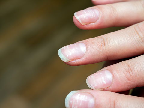 Flecken auf den Fingernägeln: Dieser Grund steckt dahinter