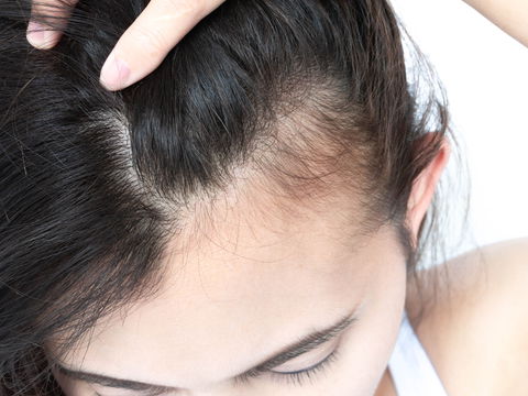 Trichotillomanie: Das müssen Sie über das zwanghafte Haareausreißen wissen