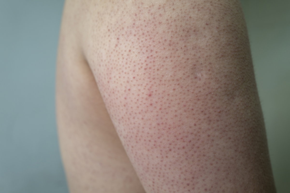 Keratosis pilaris