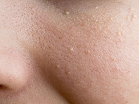 Milien im Gesicht: Diese 3 Ursachen können Schuld sein