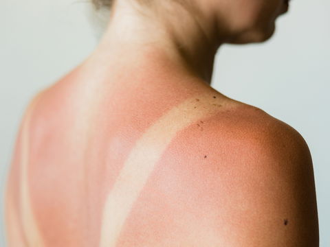 Gefährlicher Sonnenbrand: Wann wird es ernst?