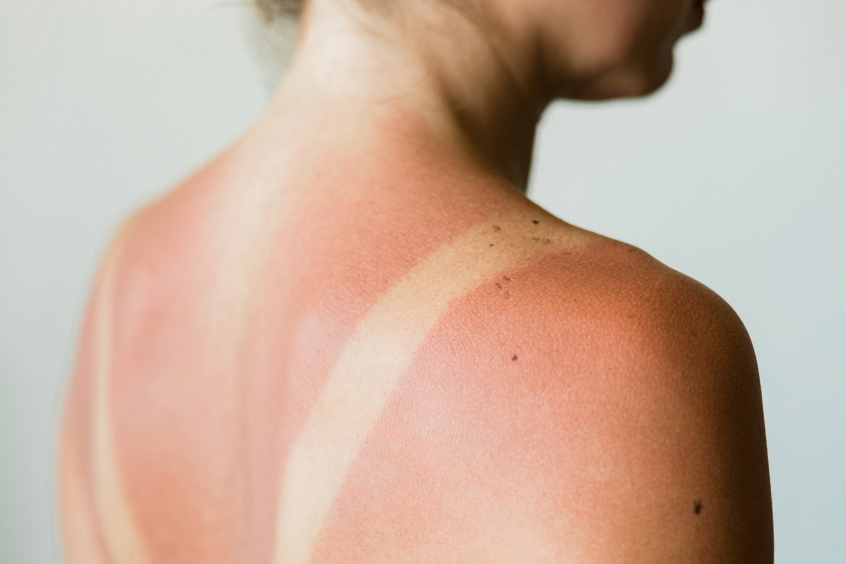 Frau mit Sonnenbrand