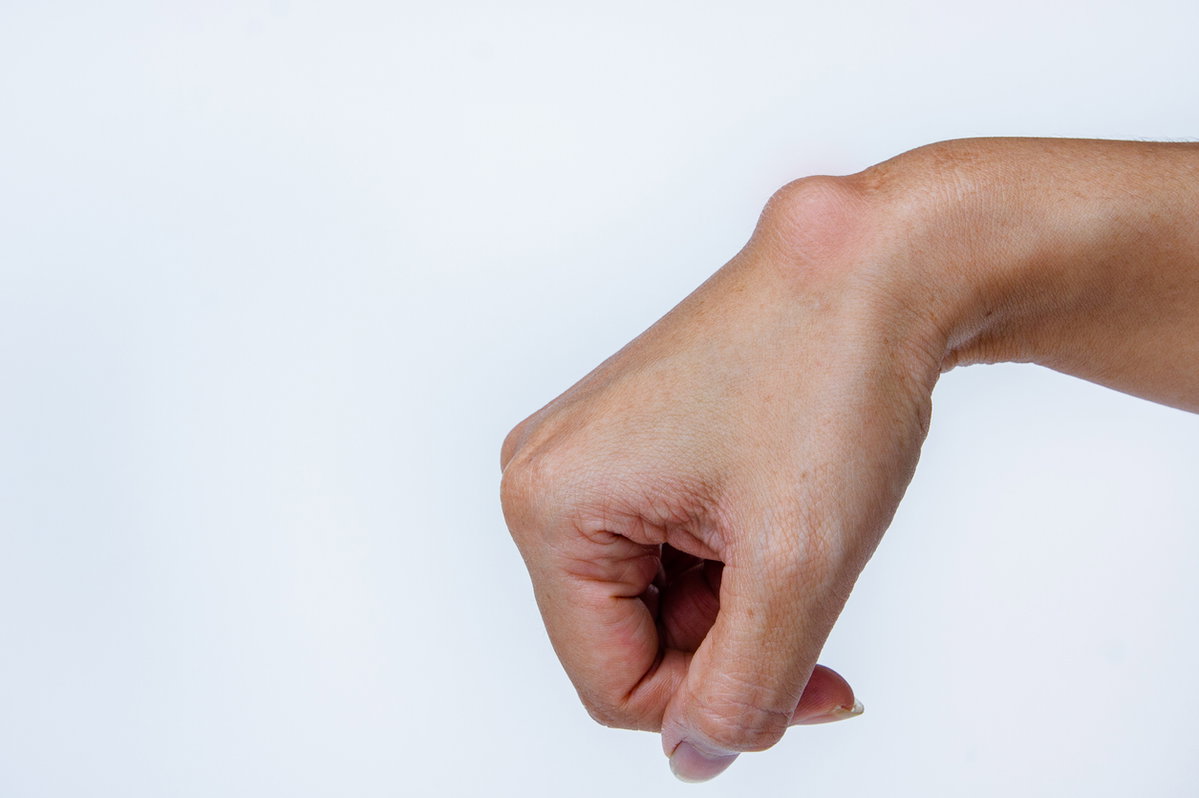 Ganglion am Handgelenk