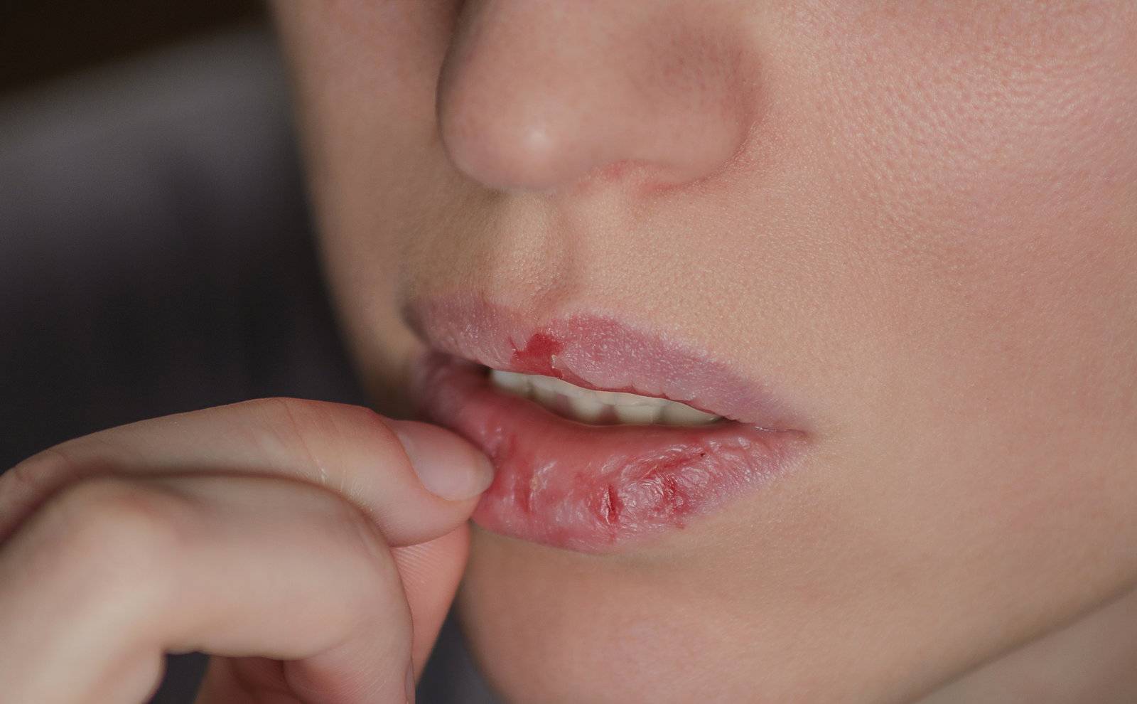 Spröde Lippen: Diese 5 Hausmittel zaubern einen zarten Kussmund