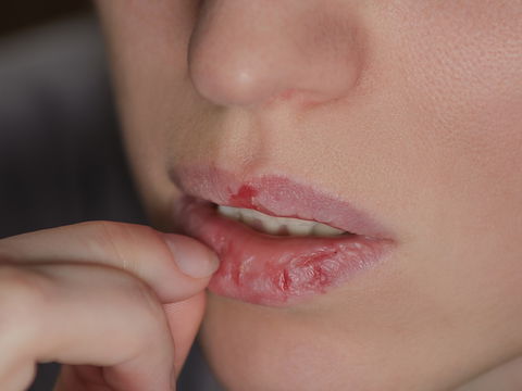 Spröde Lippen: Diese 5 Hausmittel zaubern einen zarten Kussmund