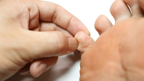 Wenn sich die Nägel verändern: Nagelpilz erkennen und vorbeugen