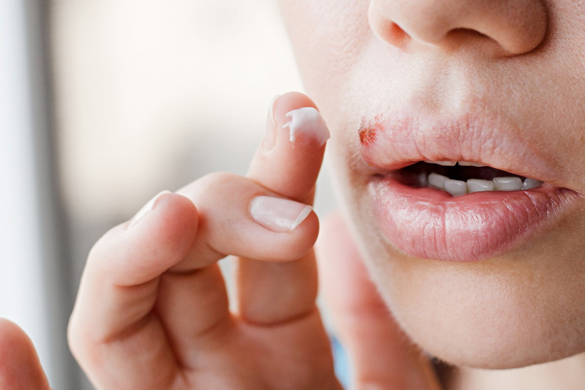 An Lippenherpes erkrankt: Symptome und Verlauf