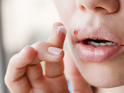 An Lippenherpes erkrankt: Symptome und Verlauf