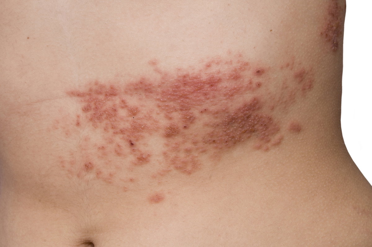 Gürtelrose mit typischem Hautausschlag am Torso.