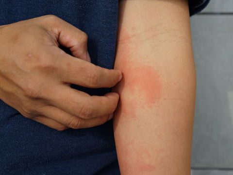 Ausschlag in der Armbeuge: Das bedeuten die roten Flecken auf der Haut