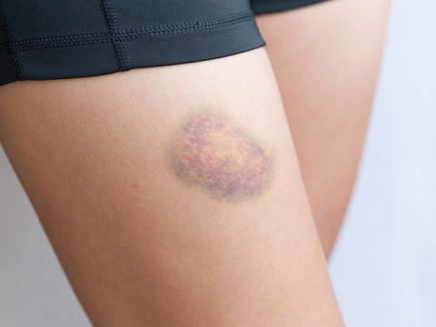 Wenn blaue Flecken hier auftreten, kann es gefährlich sein