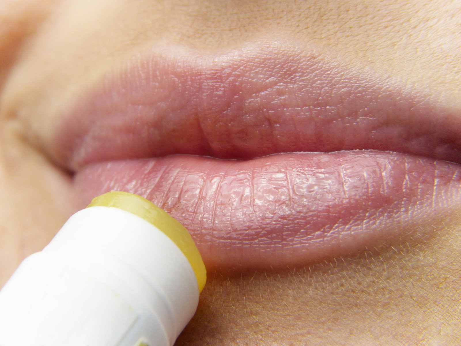 Lippenherpes: Tipps zur Vorbeugung und effektiven Bekämpfung
