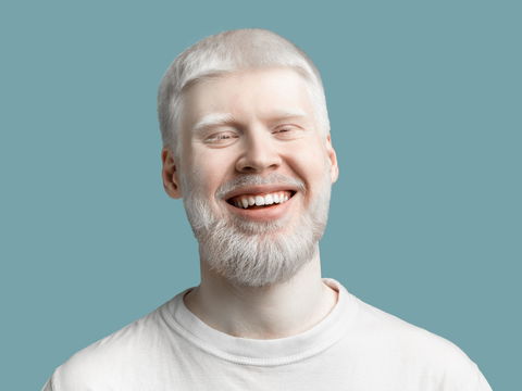 Albinismus: So gefährlich ist die Erbkrankheit wirklich