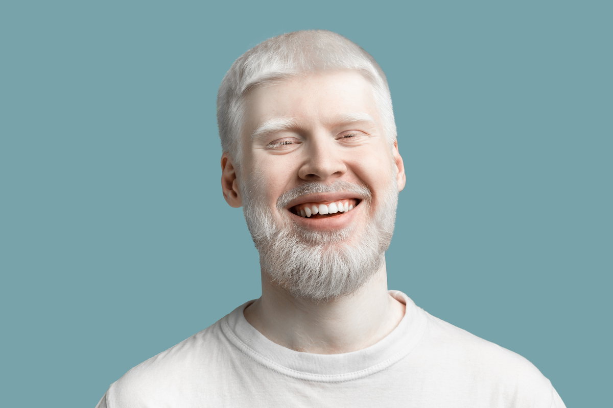 Mann mit Albinismus