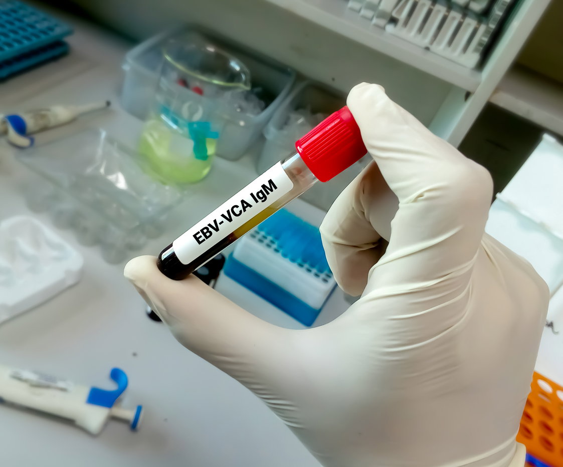 Laboruntersuchungen des EBV-Virus