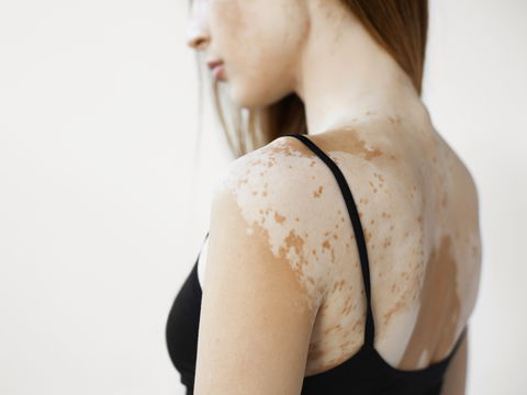 Vitiligo: So kommt es zu den Pigmentstörungen auf der Haut