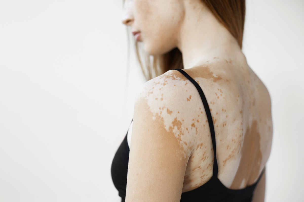 Frau mit Vitiligo-Störung am Rücken