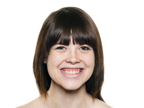 Zahnfleischlächeln: So lässt sich das "Gummy Smile" korrigieren