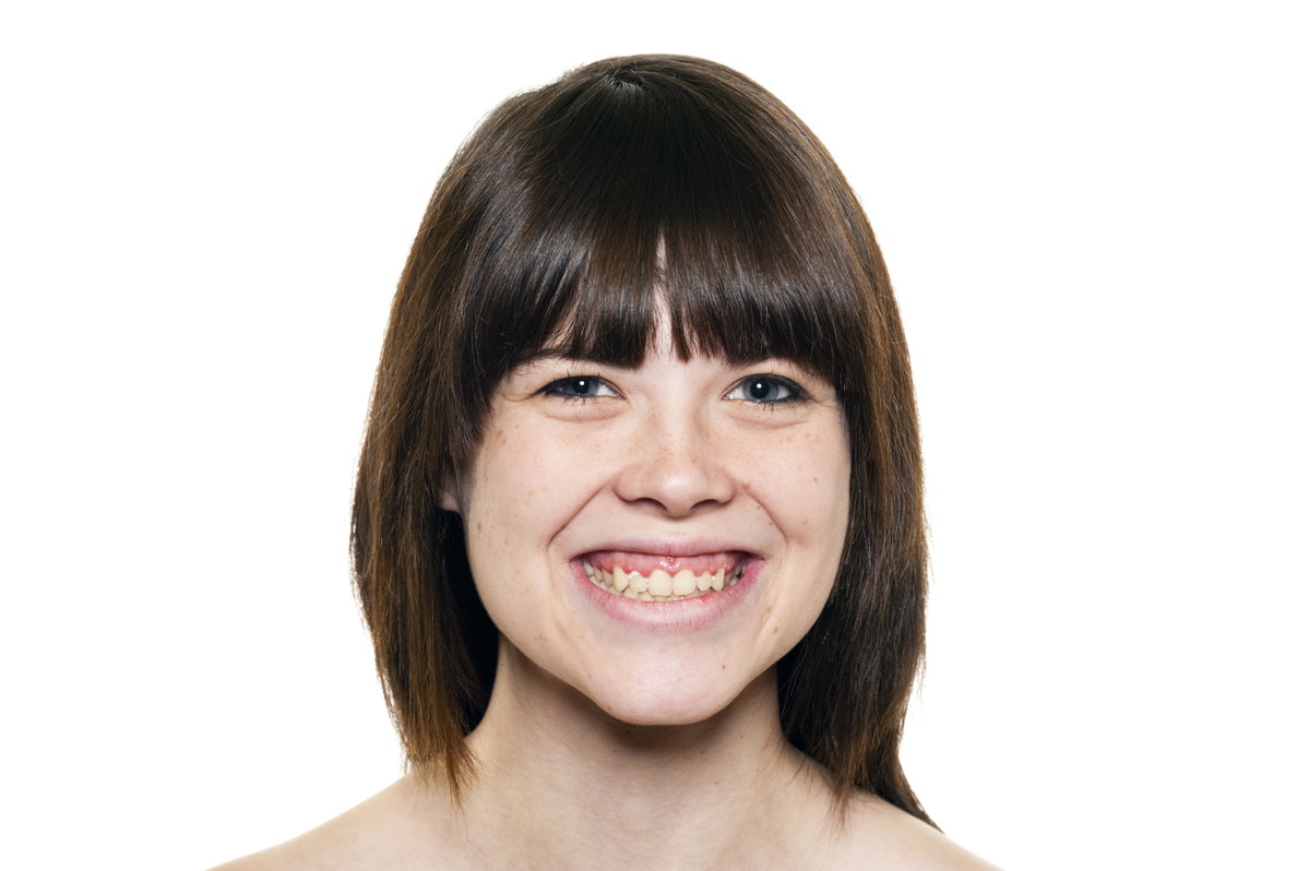 Frau mit Zahnfleischlächeln