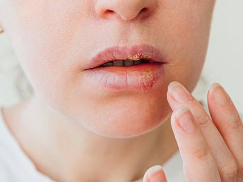 Herpes im Mund: Ursachen und Behandlungen