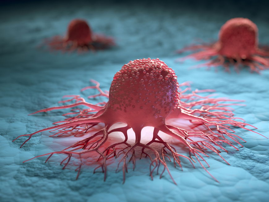 Chemotherapie und Strahlentherapie bekämpfen Darmkrebs-Zellen.