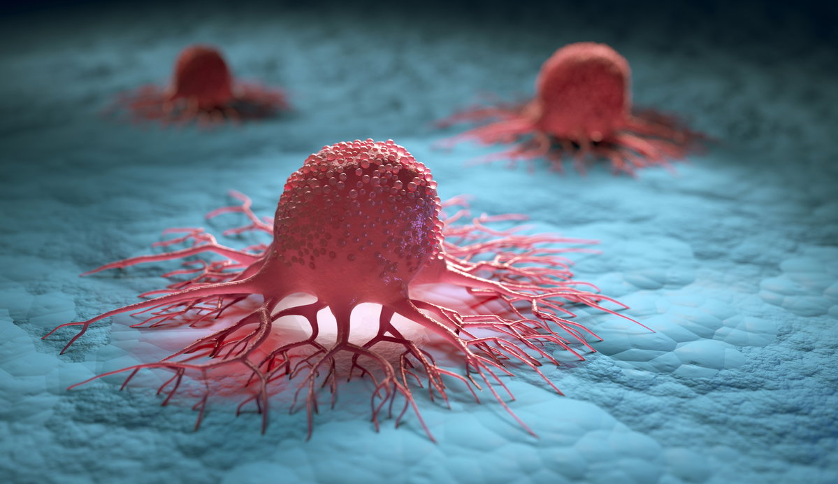 Chemotherapie und Strahlentherapie bekämpfen Darmkrebs-Zellen.